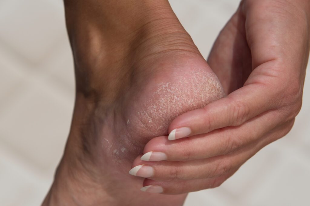 woman with cracked heels